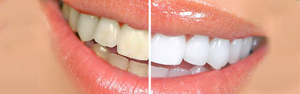 Bleaching (Beyazlatma)