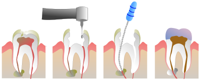 Endodonti (Kanal Tedavisi)